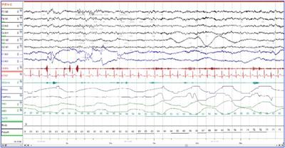 Case Report: Parasomnia Overlap Disorder Induced by Obstructive Sleep Hypopnea Apnea Syndrome: A Case Report and Literature Review